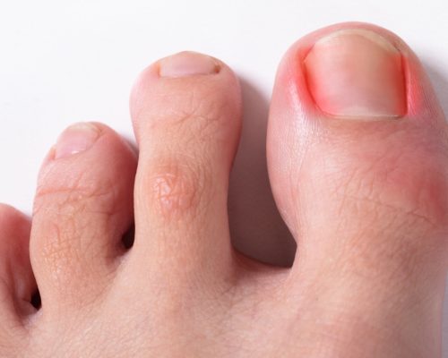 Ingrown Toenails: Foot Healers: Podiatrists